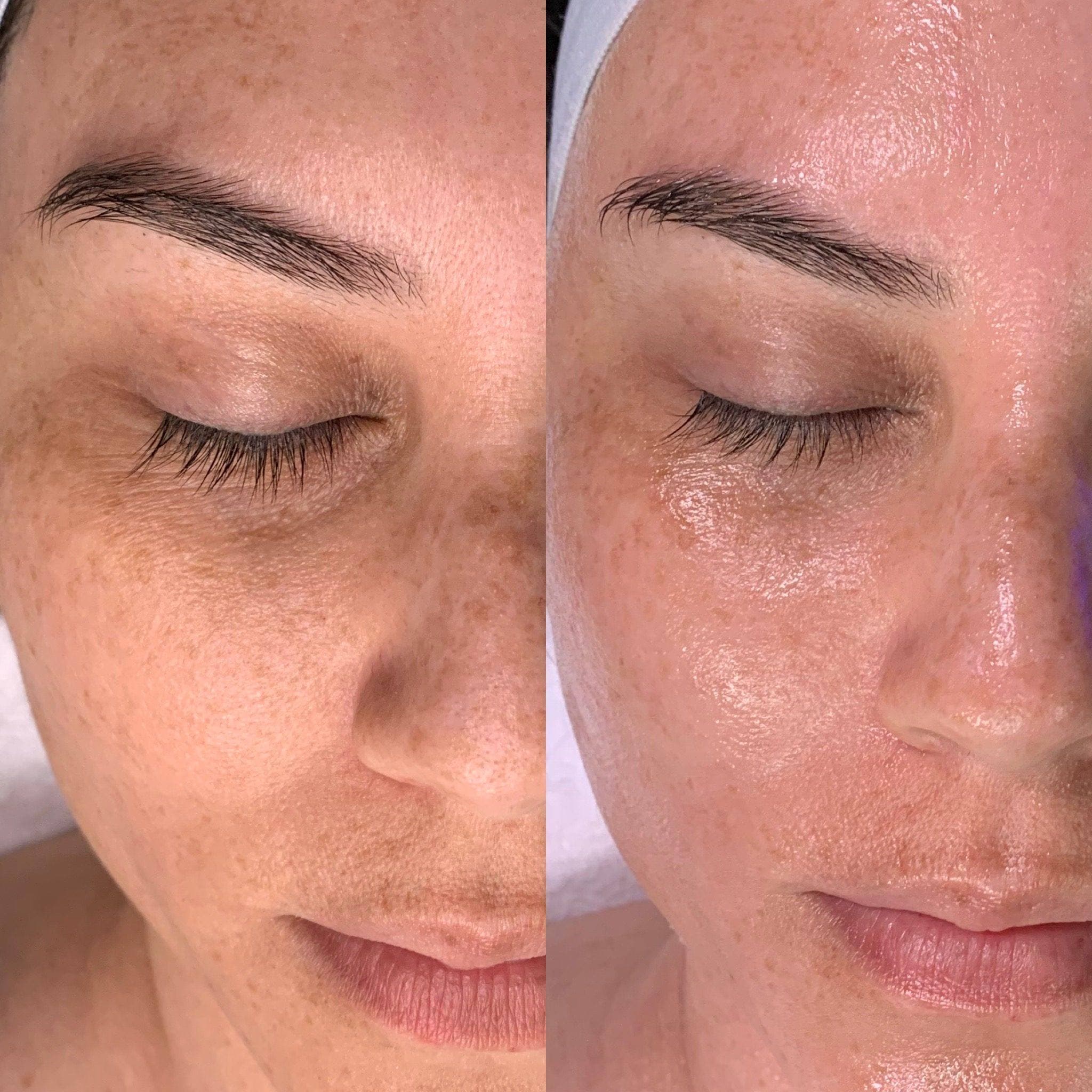 Hydrated, glowing skin after Hydrafacial